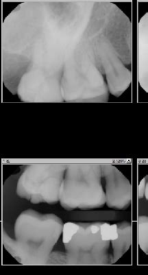 2nd molar extraction - pros and cons : r/Dentistry