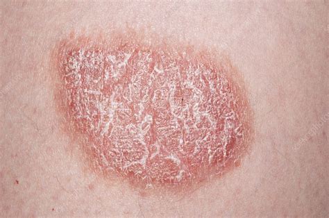 Plaque Psoriasis Debut : Les formes et localisations du psoriasis – PUSHE