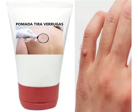 O Que E Bom Para Verruga - Pomada Para Verrugas Cair Pomada Antiverruga Berruga Natural | Frete grátis