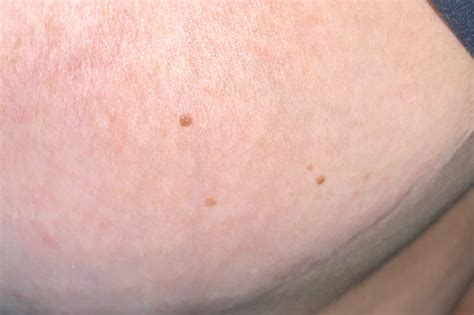 brown spots  breast glow community