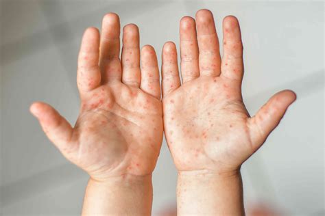 hand foot  mouth disease hfmd symptoms treatment