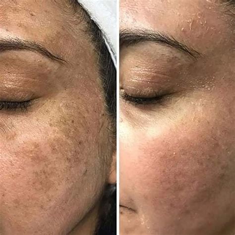 Before and After Chemical Peel Black Skin: See the WOW Results!