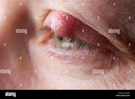 eye cyst chalazion    chalazion bump  eyelid sntlig