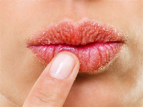 What is the main cause of chapped lips