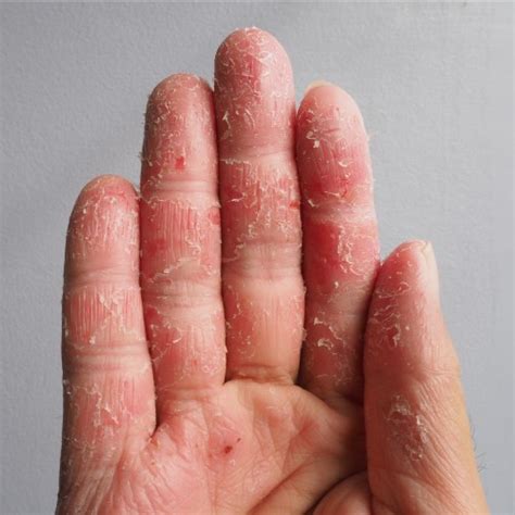 rid  eczema itching health  care