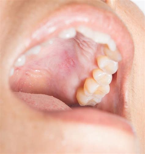 Céu Da Boca Inflamado O Que Fazer - Como tratar inflamação no céu da boca - causas e tratamentos SIMPLES