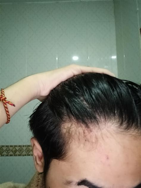 is my hairline receding? im only 15 : r/malehairadvice