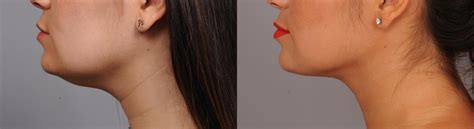 Neck Liposuction / Chin Liposuction Before and After Pictures Case 257 ...