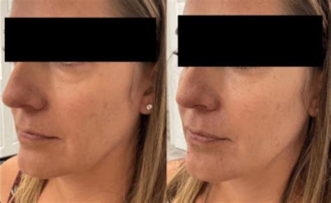 dermal fillers    zenlife md