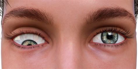 Strabismus Causes, Symptoms, Treatment | Low Vision Aids