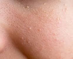 how to get rid of white spots from tanning