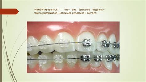 Презентация на тему: «Брекет – система» » Привет Студент!