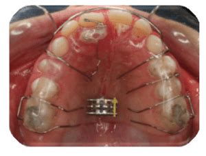 What is the best treatment method for Anterior Crossbites: fixed or ...
