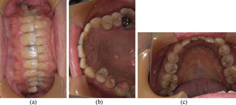 Occlusal photograph and occlusal surface images of the upper and lower ...