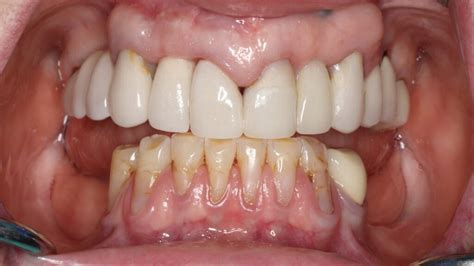 prosthodontics archives oral health group