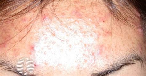 dermnet acne face image