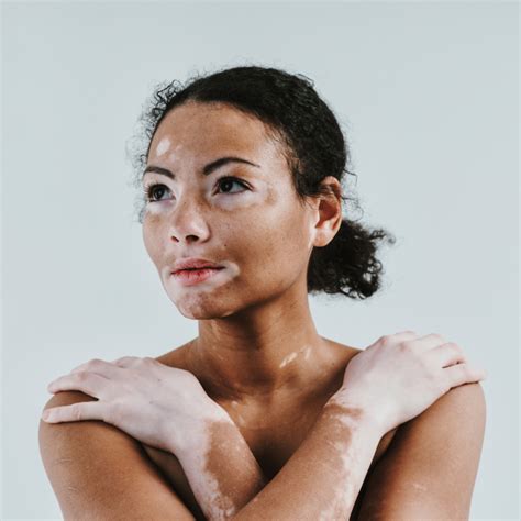 Vitiligo – Dein persönlicher Wegweiser. Mehr erfahren!