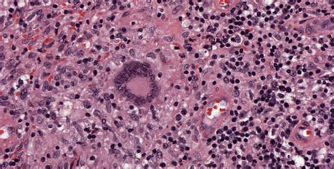 vrste granuloma zdravlje