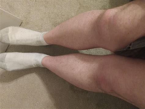 Lump appeared on leg out of nowhere. No pain or discomfort, feels