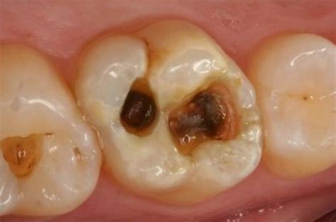 Caries Ativas E Inativas - Caries dental. Punto y aparte. Nuevos paradigmas en cariología - Blog ...