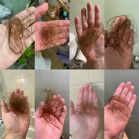 This is how November has been with my hair washes. I just got my biopsy