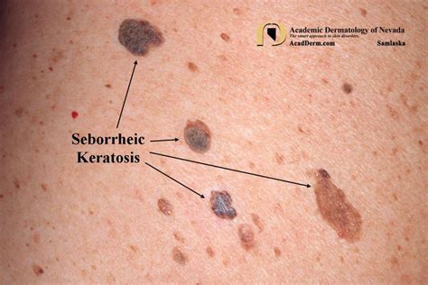 seborrheic keratosis  icd