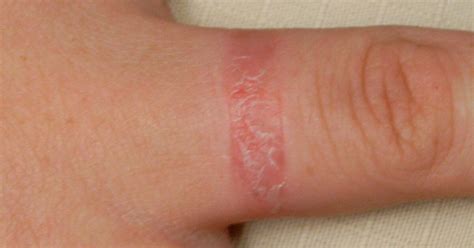 ring rash  symptoms  treatment
