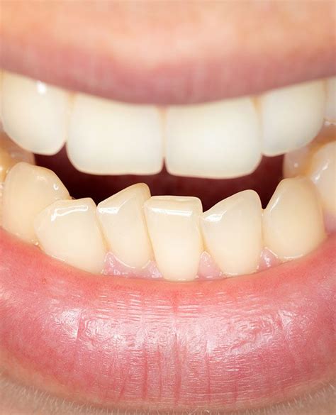 crooked teeth zenith cosmetic dentistry