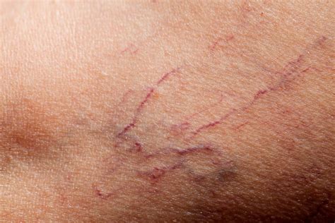 Blood Vessels In Skin