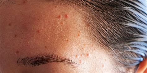 forehead acne     treatments   derms