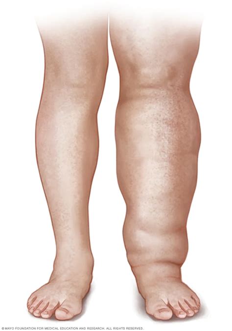 March is Lymphedema Awareness Month - CVT