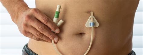 Tube Feeding (PEG and PEJ) Training for Support Workers: Face-to-Face ...