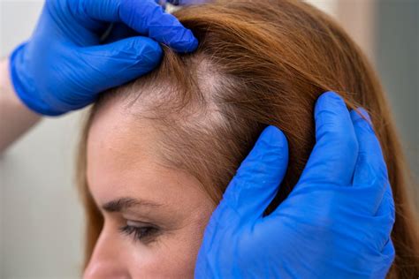 how to stop hair thinning women