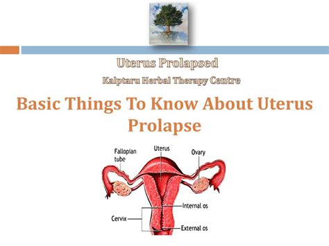 Uterus Prolapse