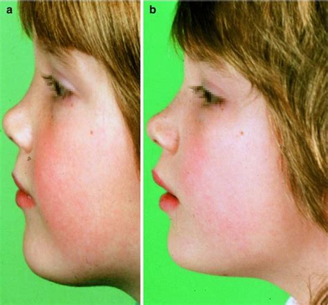 Bony Nose Growth