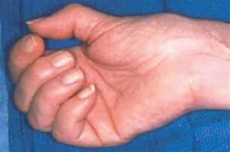 Rheumatoid Arthritis Base Of Thumb at Cinda Veloz blog