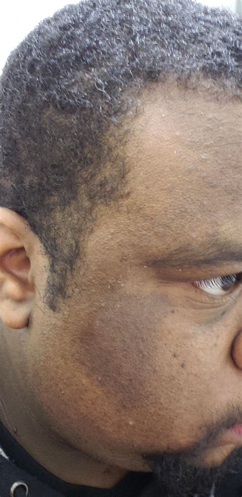 Black Spot On Face