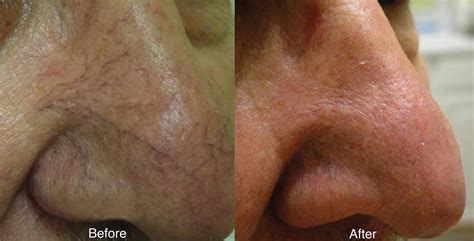 Spider Veins - medAge Aesthetics & Wellness