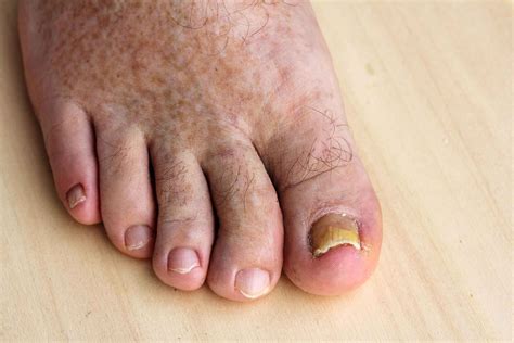 Toe Fungus