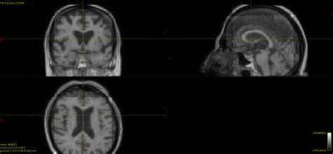 registration  axial sagittal coronal views   image mrtrix