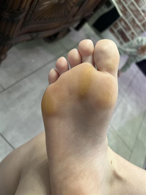 How do I get rid of these foot calluses? I hate how they’ve turned my