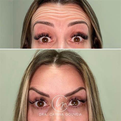 Botox Arquear Sobrancelha Antes E Depois
