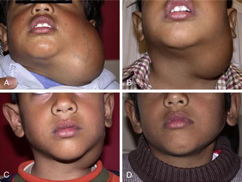 Treatment of lymphatic malformations: a more conservative approach
