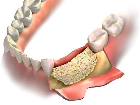 A Comprehensive Guide to Dental Bone Graft Recovery and Aftercare