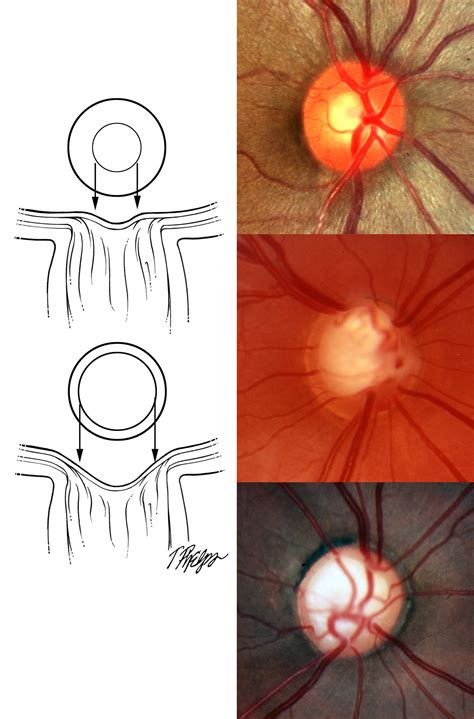 Large Optic Nerve Head