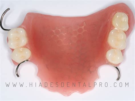 Protesis Parcial Removible