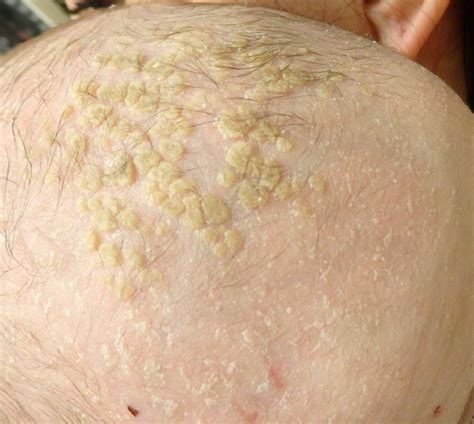 Can Alcohol Cause Seborrheic Dermatitis at Maddison Westacott blog