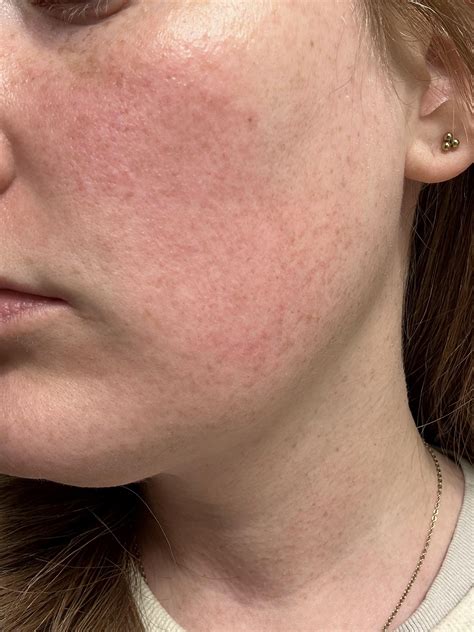 KPRF — keratosis pilaris rubra faciei : r/30PlusSkinCare