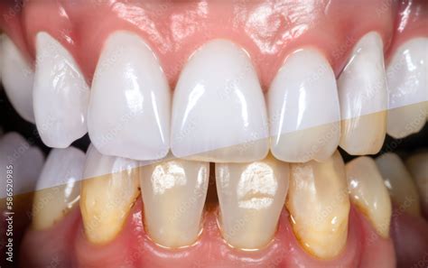 Professional teeth bleaching and cleaning, before and after results ...