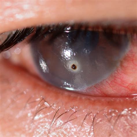 video eye trauma